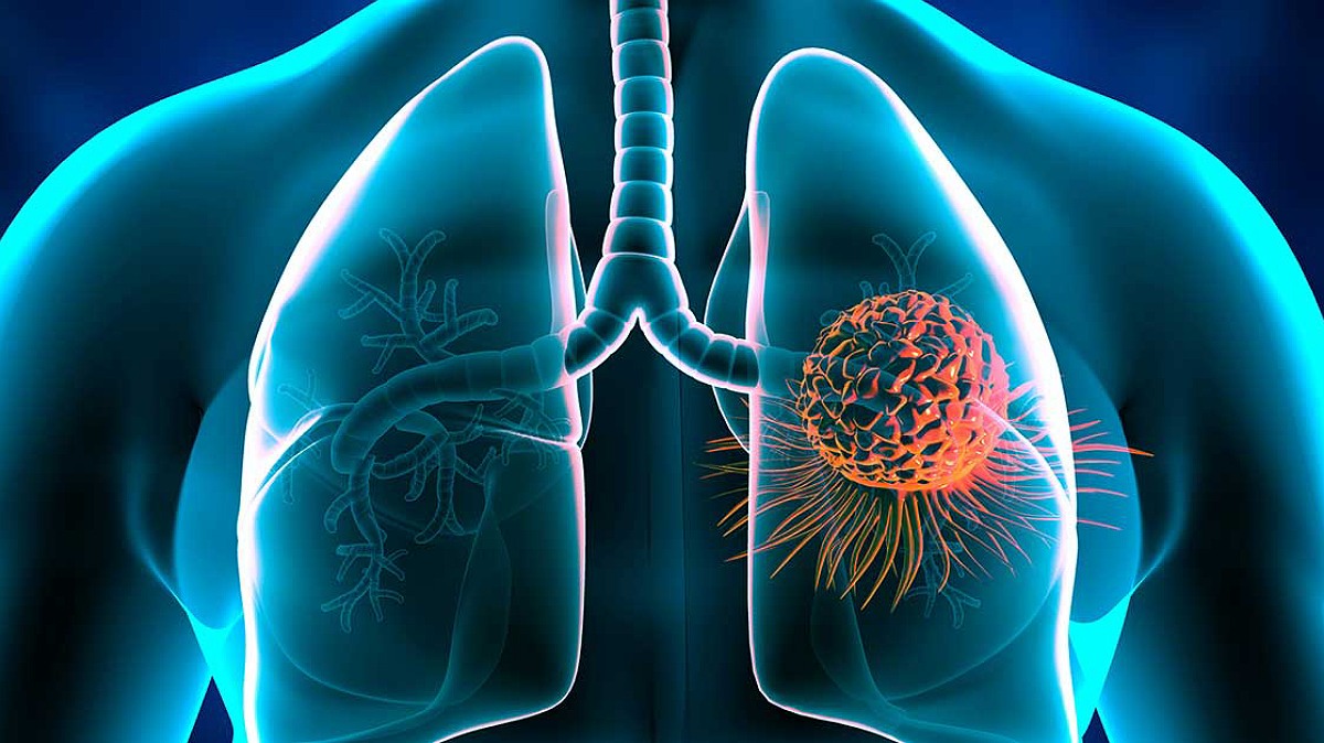 انواع بیماری های ریوی