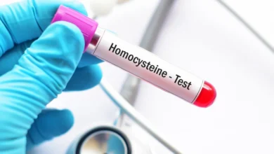 آزمایش هوموسیستئین